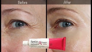 5Year RetinA Update  Before amp After for Wrinkles amp AntiAging [upl. by Kitty813]