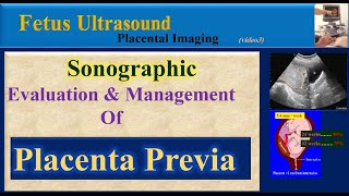 Fetus Ultrasound Placenta Previa [upl. by Inoue]