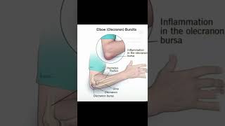 Olecranon bursitis is swelling redness and pain at the tip of the Elbow [upl. by Adnat]