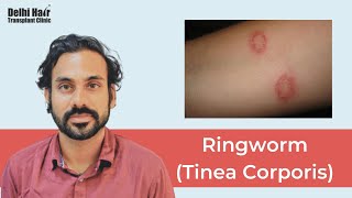 Ringworm Tinea Corporis  Causes Risk Factors Signs amp Symptoms Diagnosis and Treatment  DHTC [upl. by Genovera]