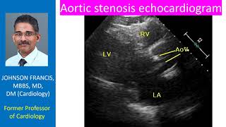 Aortic stenosis  echocardiogram [upl. by Neyud]