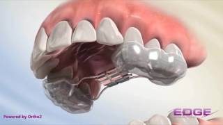 Rapid Palatal Expander RPE [upl. by Hayalat621]