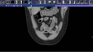 How to read a CT Enterography [upl. by Piselli]