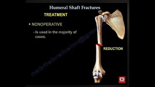 Humerus Fractures  Everything You Need To Know  Dr Nabil Ebraheim [upl. by Katinka]