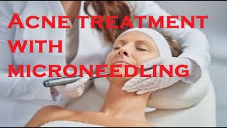 Acne treatment with microneedling [upl. by Orofselet]