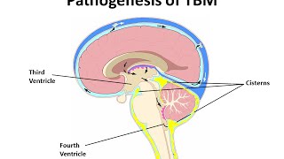 Pediatric DRTB Meningitis A CaseBased Discussion [upl. by Naujej]