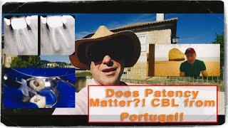 Retreatment Success Without Apical Patency CBL Vlog from Algarve Portugal [upl. by Gilburt546]