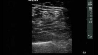 Ultrasound views of the sciatic nerve popliteal fossa [upl. by Bethany]