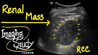 Renal Cell Carcinoma  RCC  Ultrasound  Doppler  Case 41 [upl. by Ebonee]