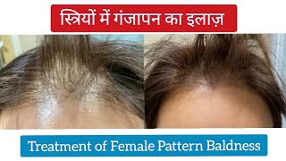 Treatment of Female Pattern Hair Loss  hair loss treatment for women  hair loss kaise roke  FPHL [upl. by Vipul]