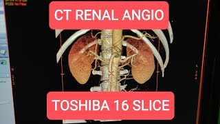 CT Renal Angiogram on Toshiba 16 Slice [upl. by Taite]