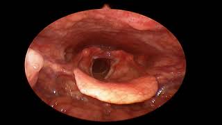 Severe acid reflux causing irritation in throatLaryngoscopic view [upl. by Delainey]