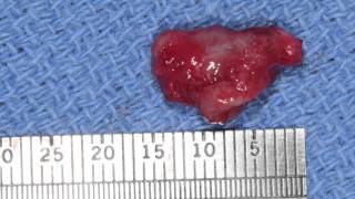 Marsupialization  Decompression of Odontogenic Cysts Part 2 [upl. by Adnolrehs]