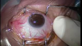 Lucentis Intravitreal Injection Technique for maculopathy [upl. by Anomar]