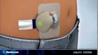 How to insert the Medtronic MiniMed Enlite sensor  diabetes therapy [upl. by Donetta]