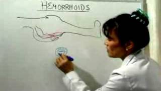 Hemorrhoid Cure What Causes Hemorrhoids [upl. by Ybba]