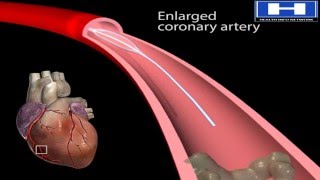 How Balloon Angioplasty is Done Animation  Coronary Angiography Procedure  Stenting in Heart Video [upl. by Nonaihr]