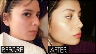 My Rhinoplasty Experience in Canada VLOG  Surgery to One Month Post Op  Nose Job Before and After [upl. by Airtal]