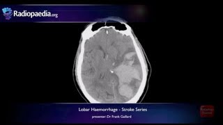 Stroke Lobar haemorrhage  radiology video tutorial MRI CT [upl. by Sherar]