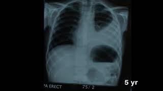 Left pleural effusion important for MRCPCH clinucal and FCPS [upl. by Eirojram]