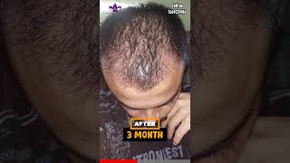 Before And After Hair transplant in Agra [upl. by Remat]