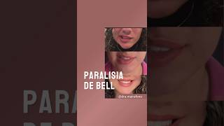 Paralisia de Bell paralisiadebell paralisiafacial [upl. by Gabbi]