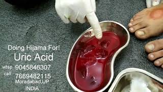 Hijama for Uric Acid Joint Pain Arthritis Cupping therapy MoradabadUP INDIA [upl. by Unity]