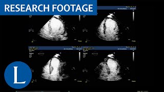 Dobutamine stress echocardiography to diagnose coronary artery disease [upl. by Sara-Ann440]