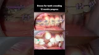 Crooked teeth Braces in 12 months progress braces orthodontics dental dentist teethbits [upl. by Granniah]