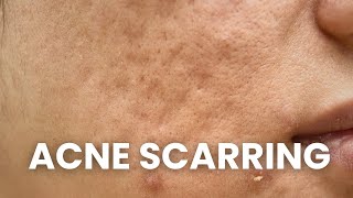 How To Get Get Rid of Acne Scars  Low Mild amp Severe Acne Scarring [upl. by Acihsay448]