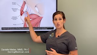 Treating Hip Bursitis  Regenerative options when traditional treatments stop working [upl. by Talbert64]