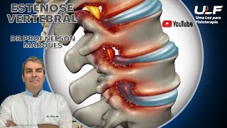 ESTENOSE VERTEBRAL  Dr Prof Nelson Marques [upl. by Roger953]