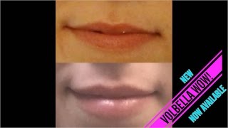 Juvederm Volbella Lip Filler Injection  Dr Rostami  Northern Virginia Washington DC Maryland [upl. by Aizitel705]