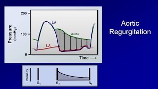 Heart murmur Aortic Stenosis Hypertrophic cardiomyopathy and etc USMLE STEP 1 [upl. by Hoxsie824]