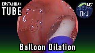 BALLOON DILATION  EUSTACHIAN TUBE  NASAL SINUS SURGERY FOOTAGE [upl. by Ogaitnas582]