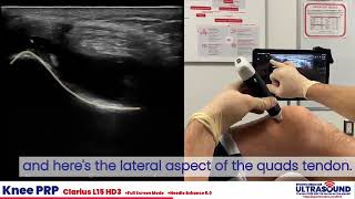 Intraarticular PRP Injection into the Suprapatellar recess demonstration [upl. by Flowers]