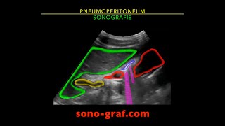 Sonographie  Pneumoperitoneum [upl. by Gottlieb]