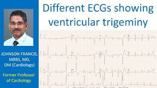 Different ECGs showing ventricular trigeminy [upl. by Ennovyhc111]