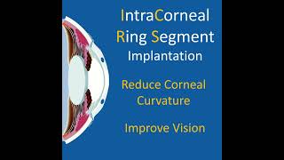 Intracorneal Ring Segment Intacs Implantation in Advanced Keratoconus [upl. by Filippa12]