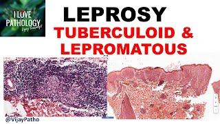 LEPROSY etiopathogenesis classification Tuberculoid amp lepromatous leprosy [upl. by Onitram962]