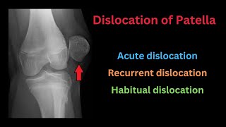 Dislocation of Patella Causes Types Pathology Clinical features Treatment amp Complications [upl. by Sedgewake]