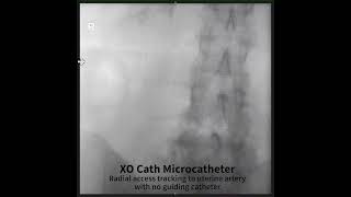 XO Cath Used in a Uterine Artery Embolization without the use of a support catheter [upl. by Reiniar]