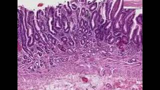 Histopathology StomachAtrophic gastritis [upl. by Bolt]