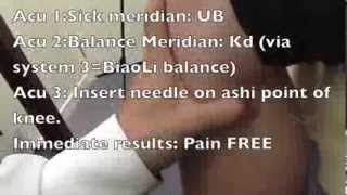 Dr Tan Balance Method Acupuncture instant relief Lower Back pain Hamilton NZ [upl. by Nadirehs179]