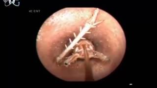 Top 7 Biggest Botfly Removal Removing Bugs in Ears [upl. by Shaya]