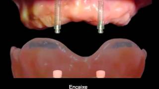 OVERDENTURE COM ORING  PRÓTESE SUPERIORmp4 [upl. by Eduard458]