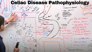 Celiac Disease Malabsorption Syndrome  Pathology  Part 1  Subash Acharya [upl. by Jacquette]