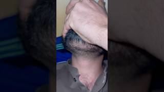 Asmr beard 🧔 barbershop haircare barber ingrownhairs ingrownhairremoval hairissue removing [upl. by Callean]