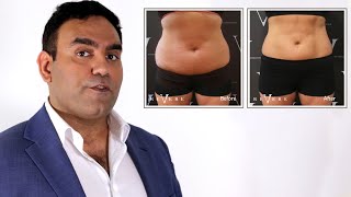 The True Cost of CoolSculpting  Revere Clinics [upl. by Crispas491]