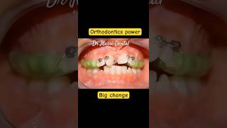 Orthodontics power Braces on crowding teeth [upl. by Yusuk]